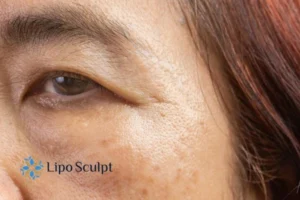 Cryopen: The Revolutionary Treatment for Age Spots Unveiled 2 Are age spots East Malling giving you low self esteem? Contact us today!